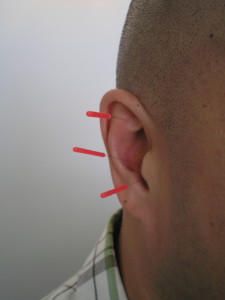 ear acupuncture